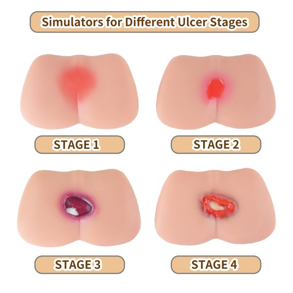 4 stages of pressure ulcer