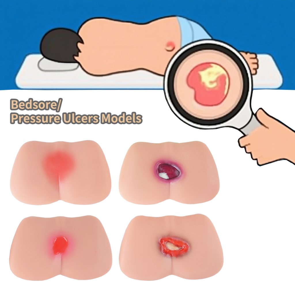 4 stages of pressure ulcer