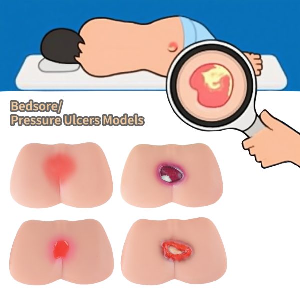 4 stages of pressure ulcer