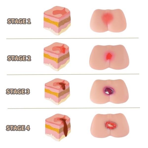 pressure ulcer wound model