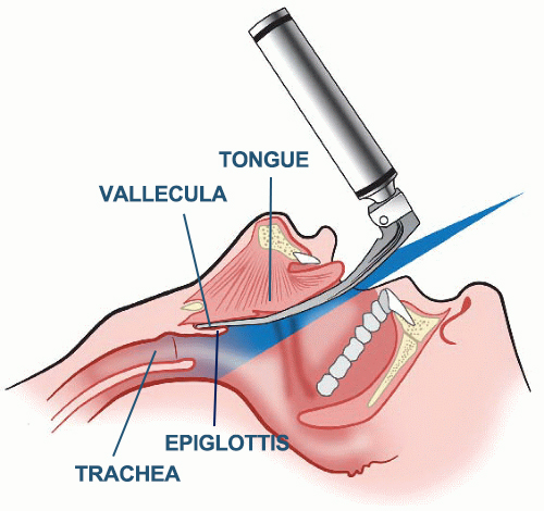 endotracheal intubation