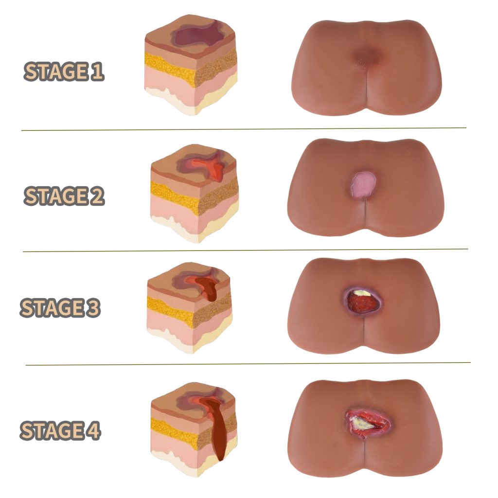 dark skin tone pressure ulcer