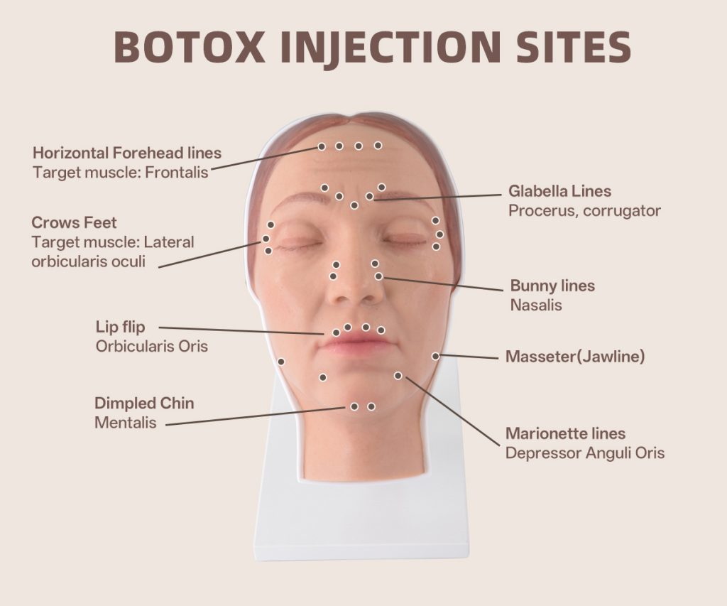 botox injection sites