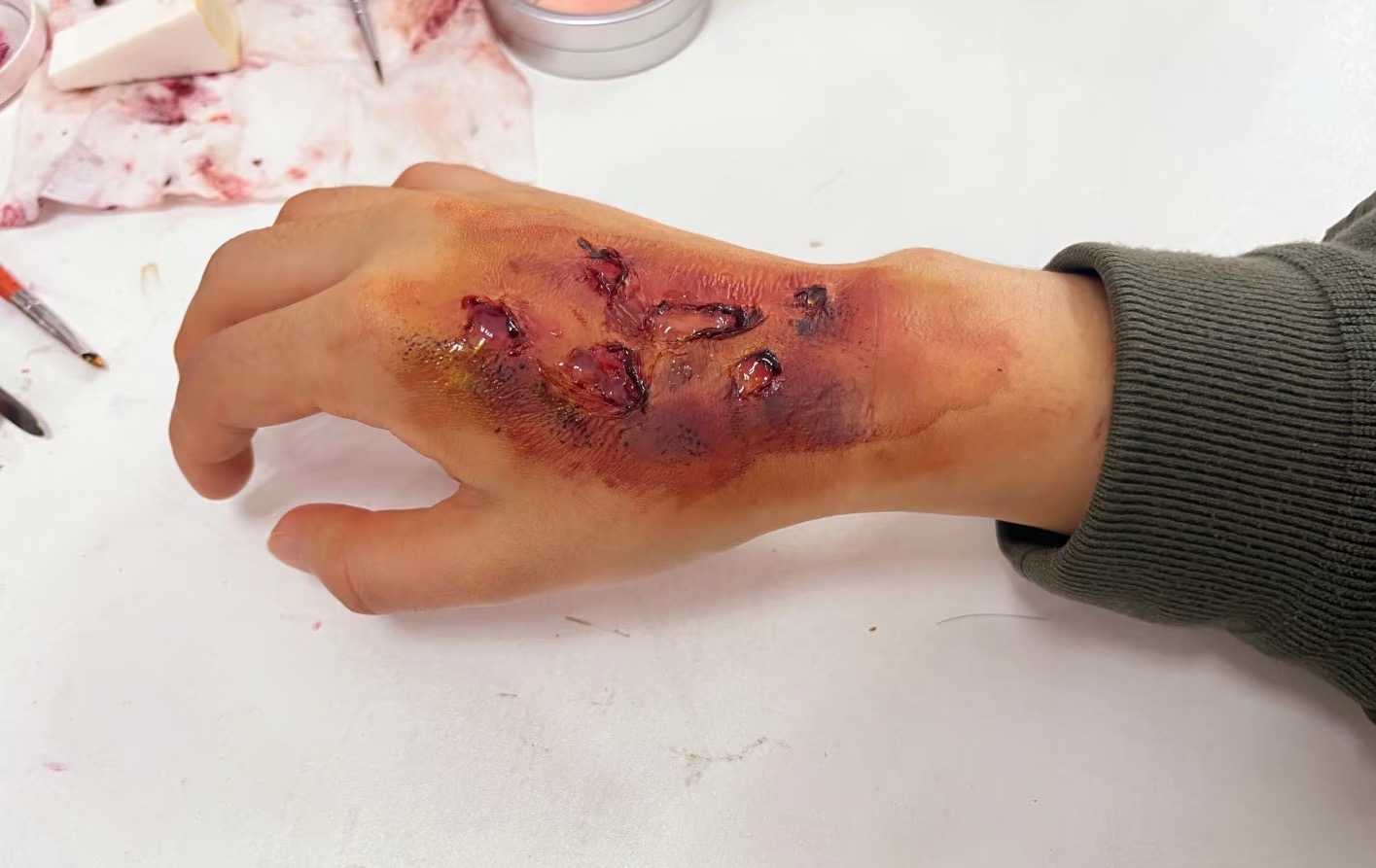 moulage burn wound