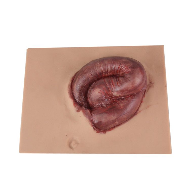 Differences between wound evisceration vs dehiscence