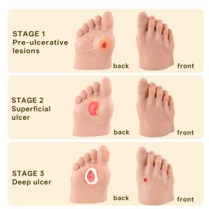 Diabetic Foot Care Simulators of 5 Stages