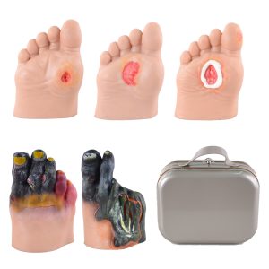 foot-ulcer-model