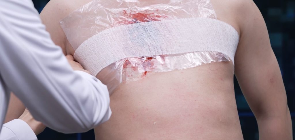 needle chest decompression with improvised tools