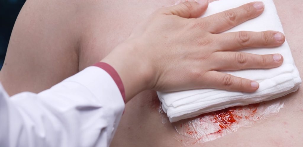 needle chest decompression with improvised tools