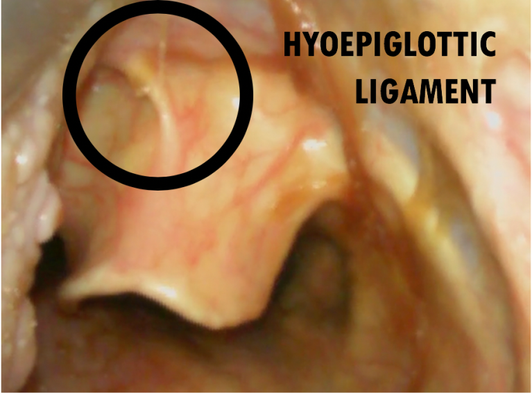 Hyoepiglottic ligament