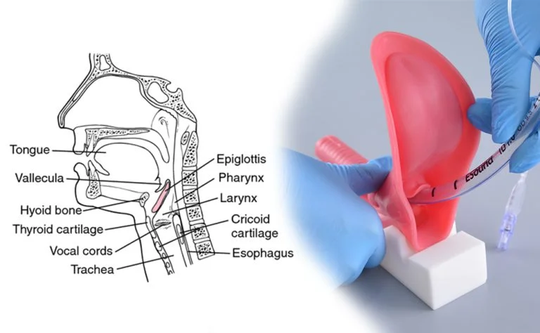 Common Endotracheal Intubation Barriers