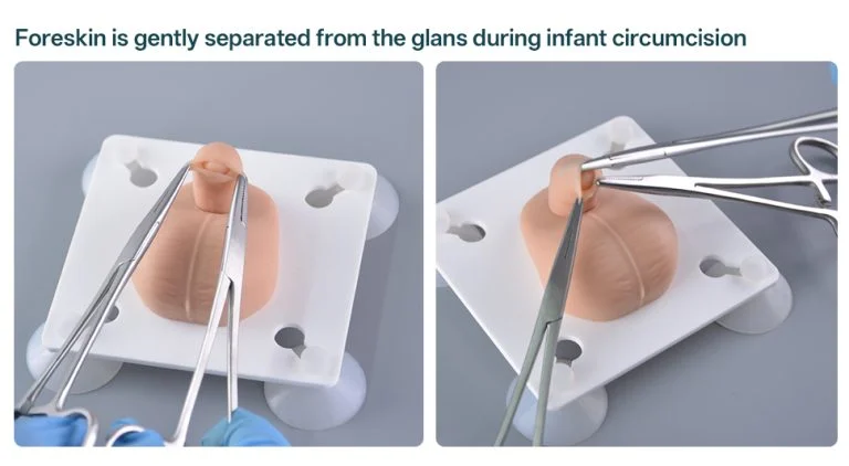 Newborn Circumcision: Procedure, Pain Relief, and Aftercare