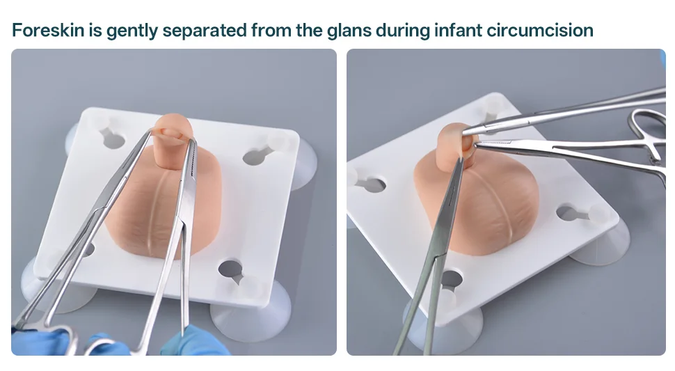 Newborn Circumcision: Procedure, Pain Relief, and Aftercare