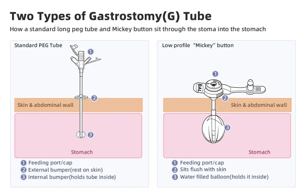 Types of gastrostomy tubes: standard long PEG tube versus a low-profile Mickey button, shown in the stomach