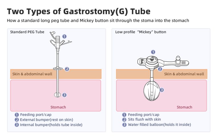 What Is a Gastrostomy (G) Tube? Types, PEG vs Surgical, and How It Compares to NG & GJ Tubes