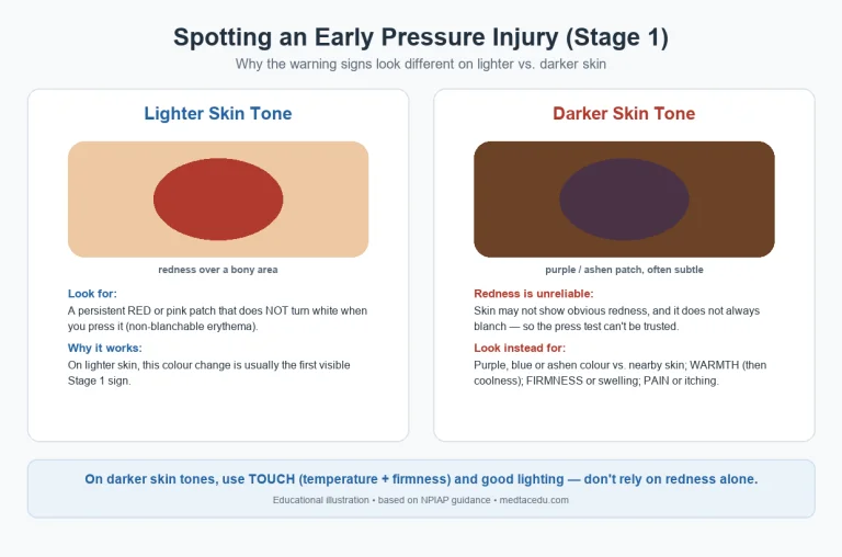 Pressure Injury Warning Signs: How to Spot a Bedsore Early (Including on Darker Skin)