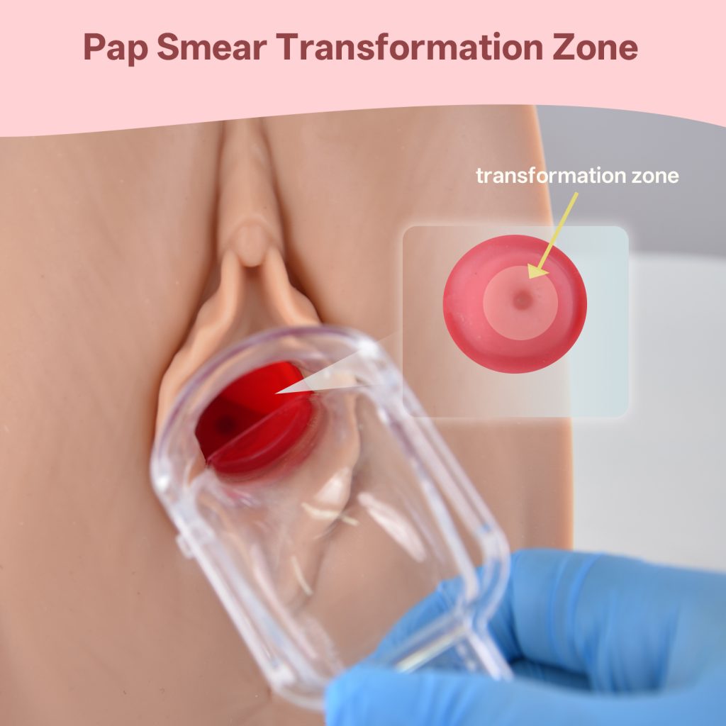pap smear transformation zone