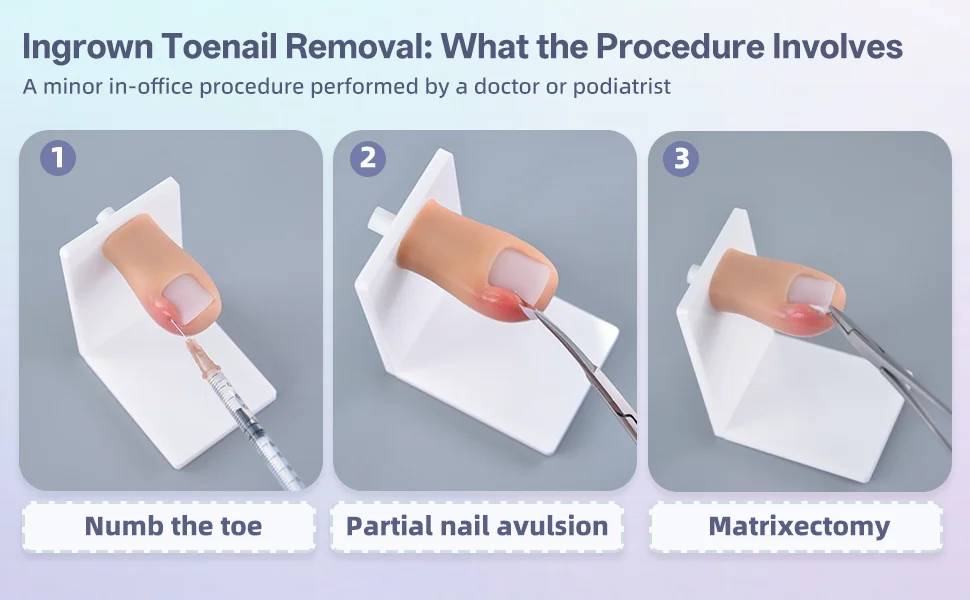 What ingrown toenail removal involves: numbing, partial nail avulsion, optional matrixectomy, and dressing