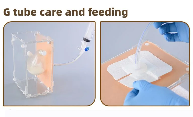 PEG Tube Placement & G-Tube Care: Feeding, Site Care, Replacement & Troubleshooting