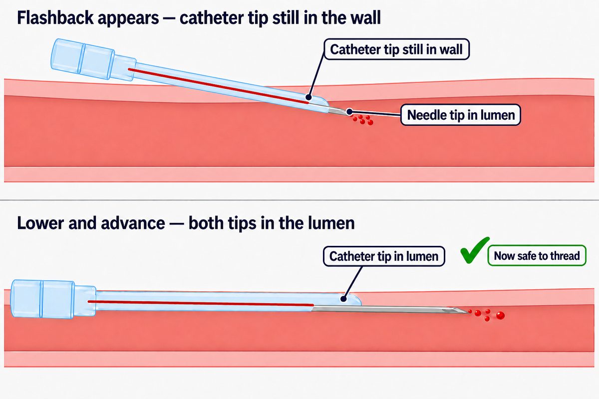 Longitudinal section of a vein showing why a catheter will not advance after flashback: in the upper panel the needle tip is inside the lumen while the catheter tip is still within the vessel wall; in the lower panel the assembly has been lowered and advanced so both tips are inside the lumen