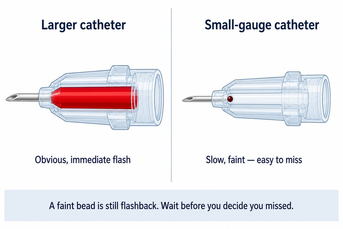 Comparison of flashback in two catheter hubs: a larger-bore hub filling with bright blood, and a narrower small-gauge hub showing only a single dark bead of blood