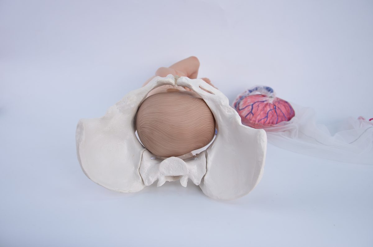 Fetal doll head entering the pelvic inlet sideways, viewed from below, on a pelvis model