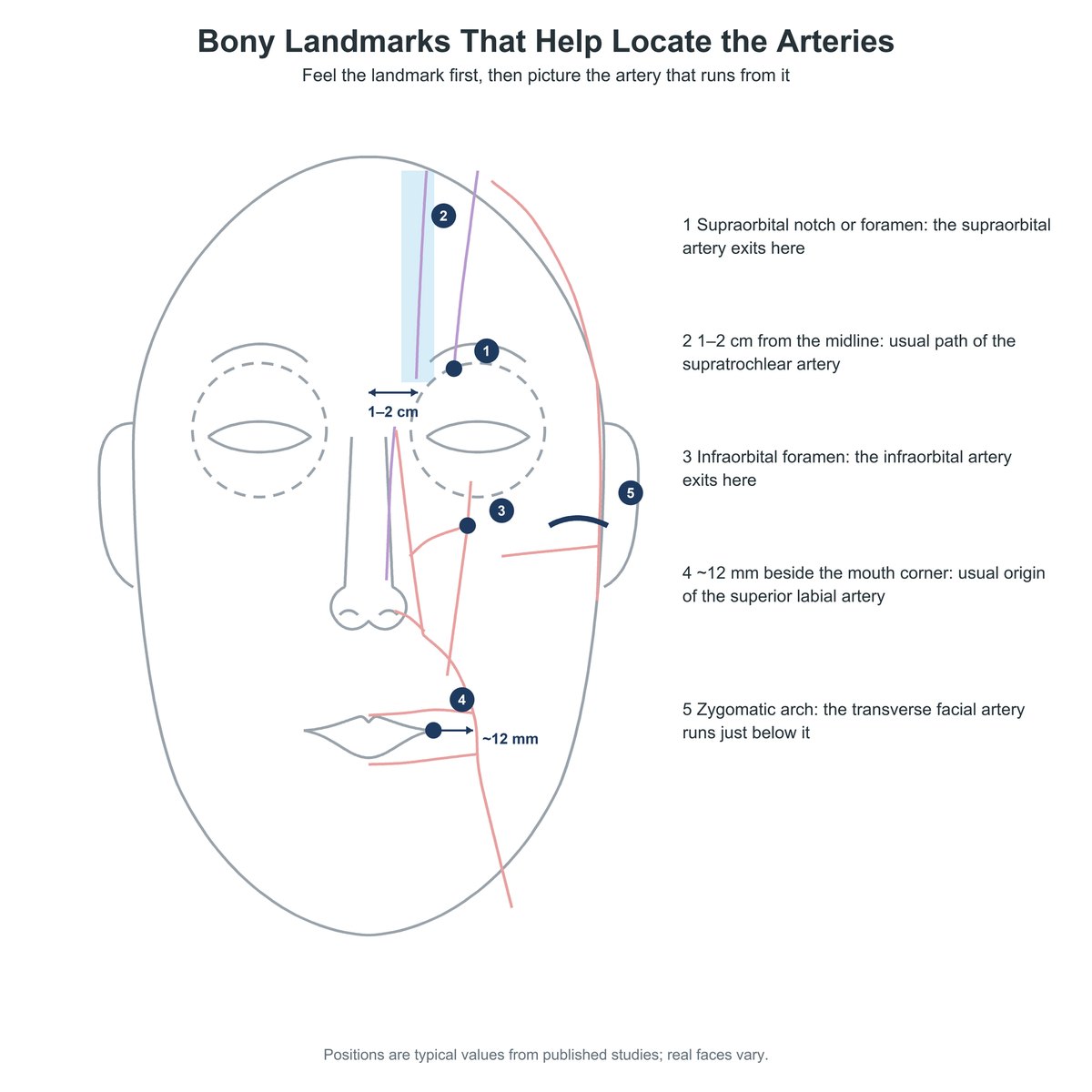 Diagram of five bony landmarks used to locate facial arteries: supraorbital notch, 1 to 2 cm from the midline, infraorbital foramen, about 12 mm beside the mouth corner, and the zygomatic arch
