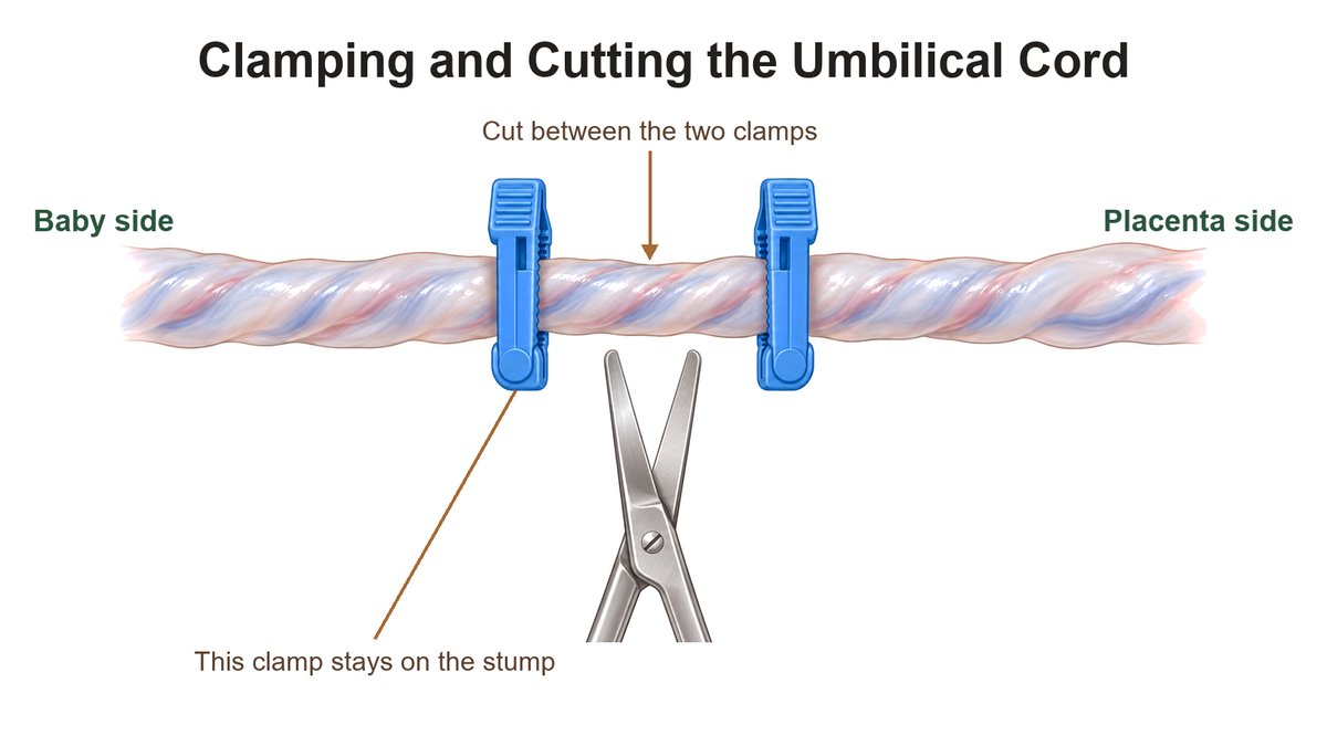 Diagram of an umbilical cord with two clamps and scissors positioned to cut between them, with the baby-side clamp labeled as the one that stays on the stump