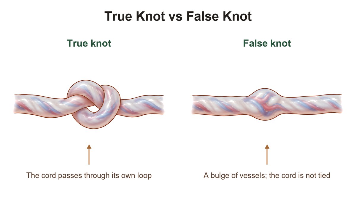 Illustration comparing a true knot in the umbilical cord, where the cord passes through its own loop, with a false knot, a localized bulge of vessels on a straight cord